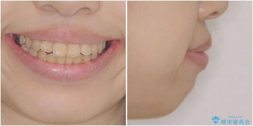 上下の出っ歯を治したい　ワイヤー装置による抜歯矯正の治療前（顔貌）