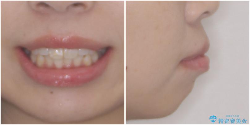 口元の突出感改善　なるべく銀歯を抜歯してワイヤー矯正の治療前（顔貌）