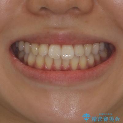 インビザラインで口を閉じやすくの治療前(顔貌)