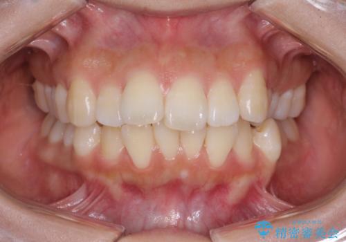 【審美ワイヤー】抜歯矯正の治療前