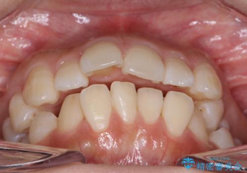 【審美ワイヤー】抜歯矯正の治療前