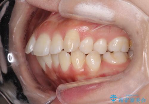 【審美ワイヤー】抜歯矯正の治療前