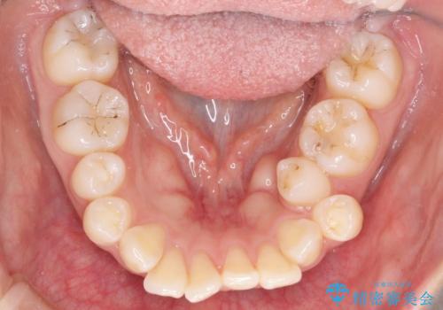 【審美ワイヤー】抜歯矯正の治療前