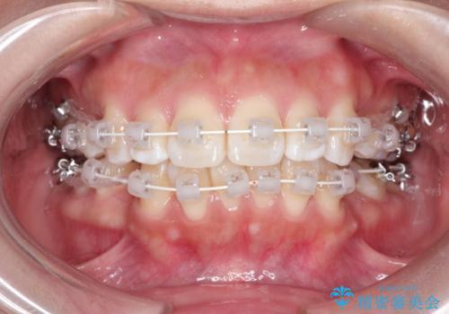 【審美ワイヤー】抜歯矯正の治療中