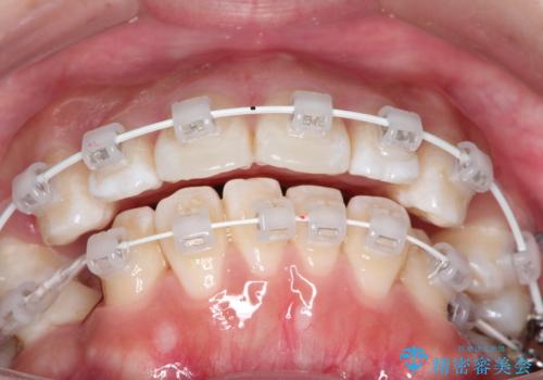 【審美ワイヤー】抜歯矯正の治療中