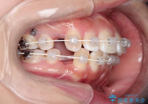 【審美ワイヤー】抜歯矯正の治療中