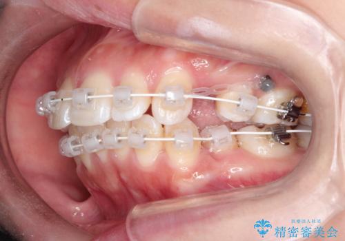 【審美ワイヤー】抜歯矯正の治療中