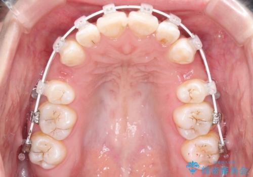 【審美ワイヤー】抜歯矯正の治療中