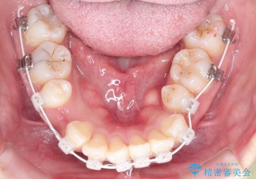 【審美ワイヤー】抜歯矯正の治療中