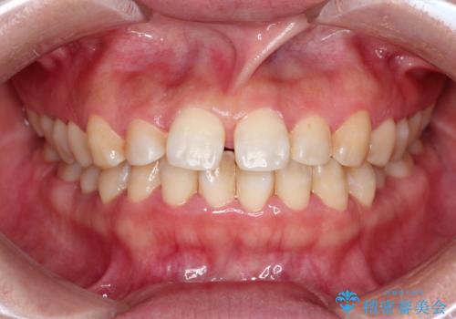 【インビザライン】前歯のすきまを閉じたいの症例 治療前