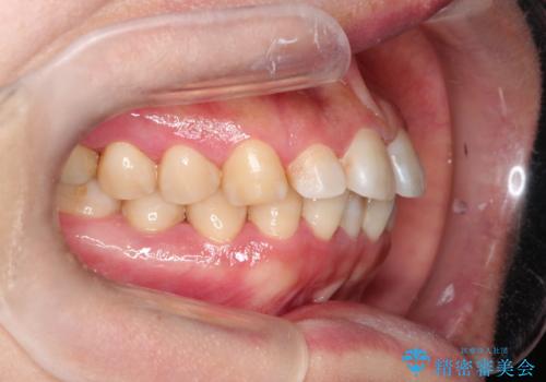 【インビザライン】前歯のすきまを閉じたいの治療前