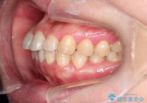 【インビザライン】前歯のすきまを閉じたいの治療前