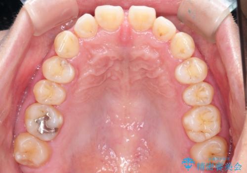 【インビザライン】前歯のすきまを閉じたいの治療前