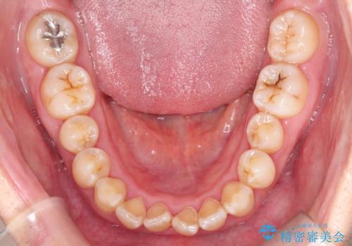 【インビザライン】前歯のすきまを閉じたいの治療前