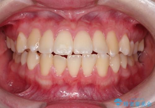 【インビザライン】歯を抜かずにできるだけ前歯を下げたいの症例 治療前