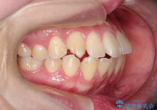 【インビザライン】歯を抜かずにできるだけ前歯を下げたいの治療前