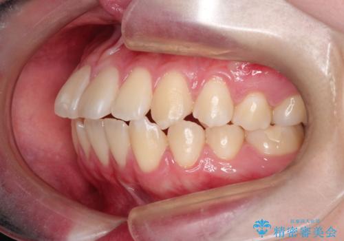【インビザライン】歯を抜かずにできるだけ前歯を下げたいの治療前