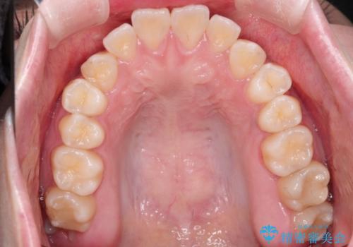 【インビザライン】歯を抜かずにできるだけ前歯を下げたいの治療前