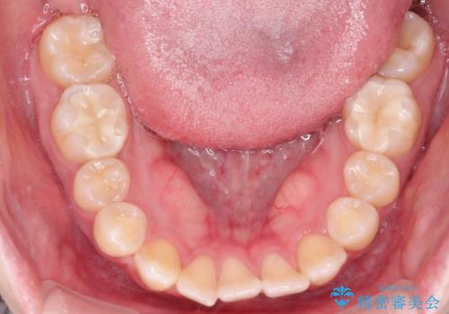 【インビザライン】歯を抜かずにできるだけ前歯を下げたいの治療前