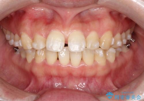 【インビザライン】前歯のすきまを閉じたいの治療中