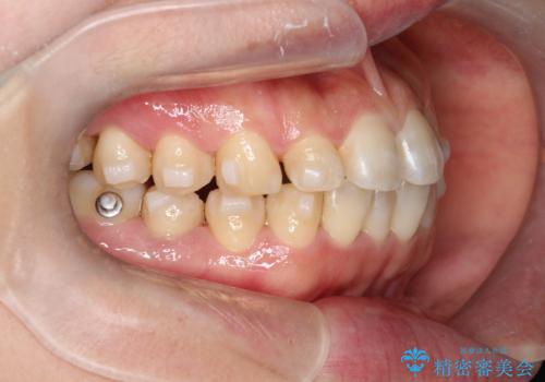 【インビザライン】前歯のすきまを閉じたいの治療中