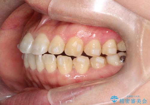 【インビザライン】前歯のすきまを閉じたいの治療中