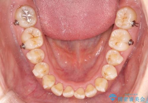 【インビザライン】前歯のすきまを閉じたいの治療中