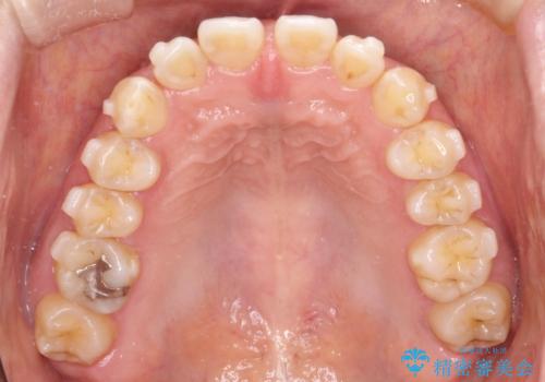 【インビザライン】前歯のすきまを閉じたいの治療中