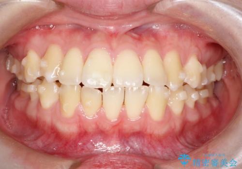 【インビザライン】歯を抜かずにできるだけ前歯を下げたいの治療中