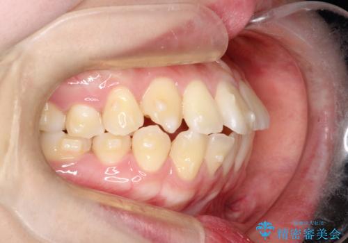 【インビザライン】歯を抜かずにできるだけ前歯を下げたいの治療中