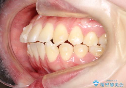 【インビザライン】歯を抜かずにできるだけ前歯を下げたいの治療中