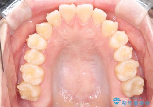 【インビザライン】歯を抜かずにできるだけ前歯を下げたいの治療中