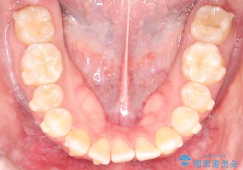 【インビザライン】歯を抜かずにできるだけ前歯を下げたいの治療中