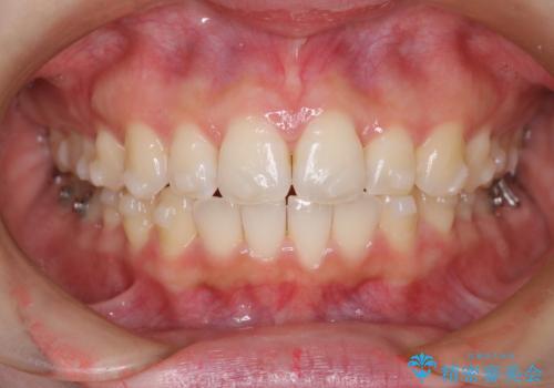 【インビザライン】前歯が出てるのを治したいの治療中