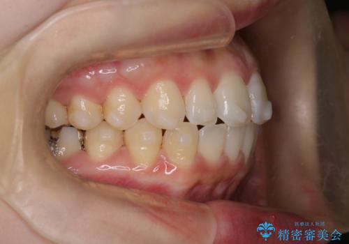 【インビザライン】前歯が出てるのを治したいの治療中