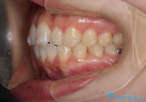 【インビザライン】前歯が出てるのを治したいの治療中