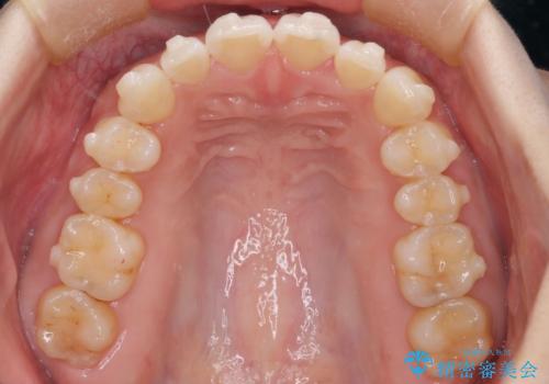 【インビザライン】前歯が出てるのを治したいの治療中