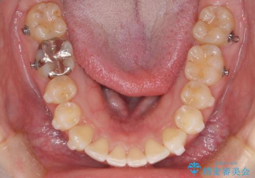 【インビザライン】前歯が出てるのを治したいの治療中