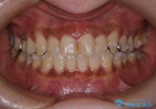 【インビザライン】前歯の凸凹をなおしたいの治療中