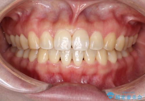 【インビザライン】前歯のすきまを閉じたいの症例 治療後