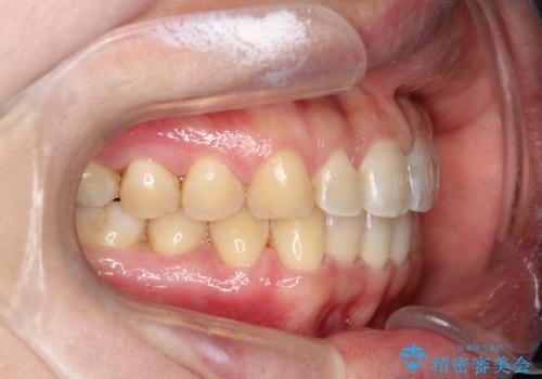 【インビザライン】前歯のすきまを閉じたいの治療後