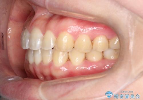 【インビザライン】前歯のすきまを閉じたいの治療後