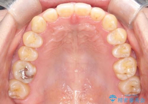 【インビザライン】前歯のすきまを閉じたいの治療後