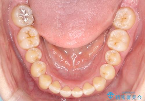 【インビザライン】前歯のすきまを閉じたいの治療後