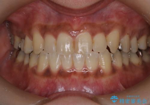 【インビザライン】前歯の凸凹をなおしたいの治療後