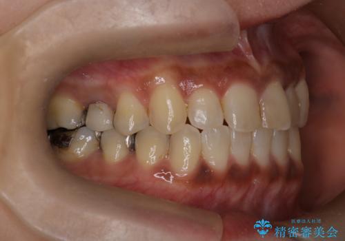 【インビザライン】前歯の凸凹をなおしたいの治療後