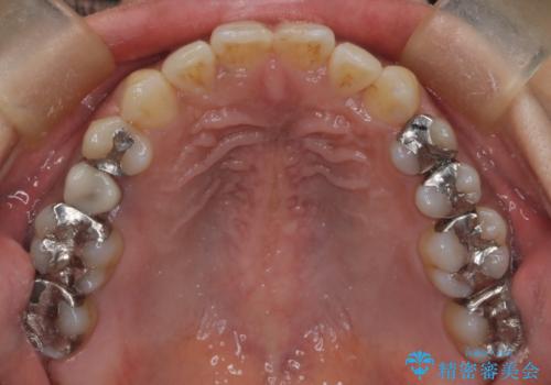 【インビザライン】前歯の凸凹をなおしたいの治療後