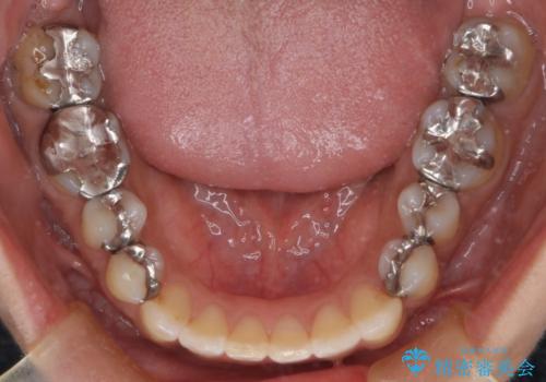 【インビザライン】前歯の凸凹をなおしたいの治療後