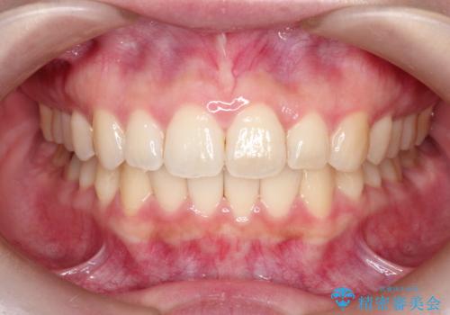 【インビザライン】前歯が出てるのを治したいの症例 治療後