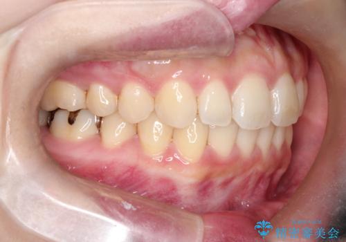 【インビザライン】前歯が出てるのを治したいの治療後